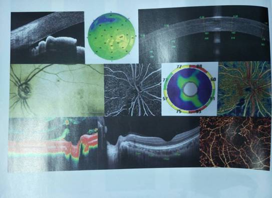 光学相干断层扫描仪（OCT）